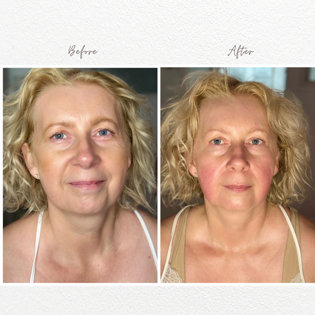 Before and after results - Natural face lifting transformation