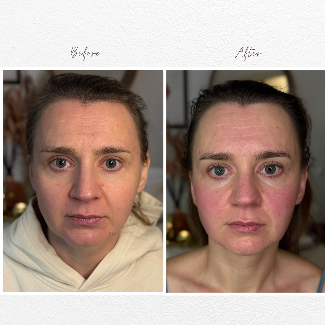Before and after results - Natural face lifting transformation