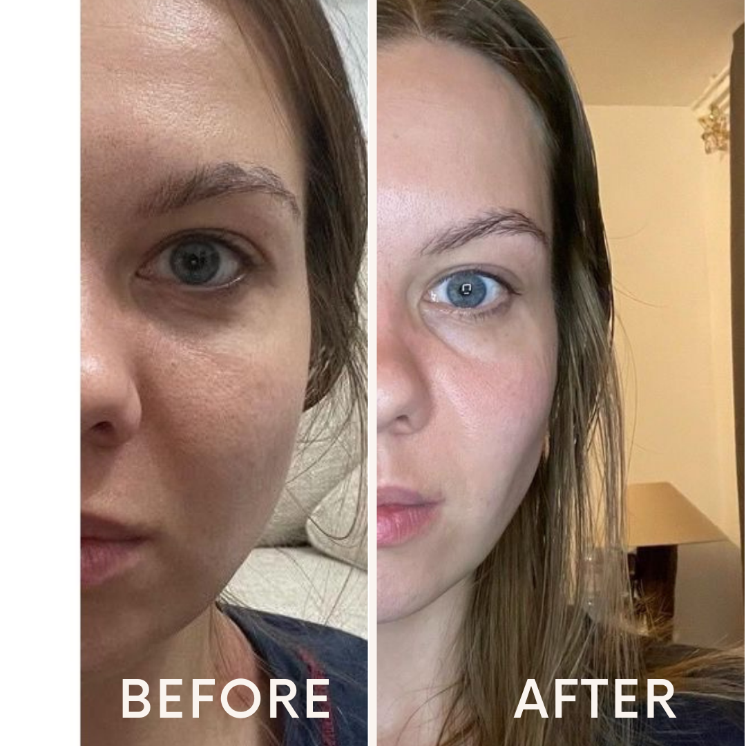 Before and after results - Natural face lifting transformation